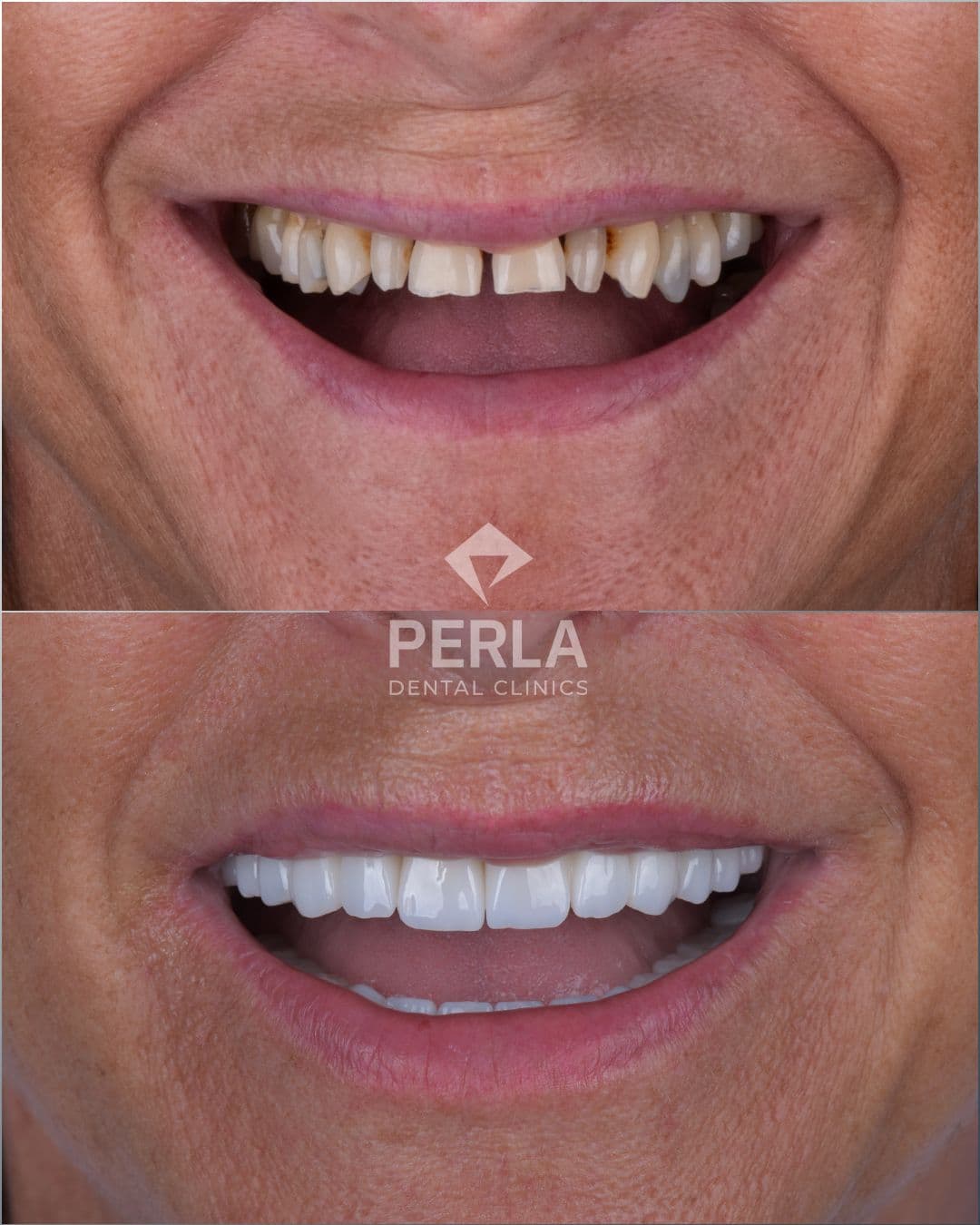 Dental treatment result 4